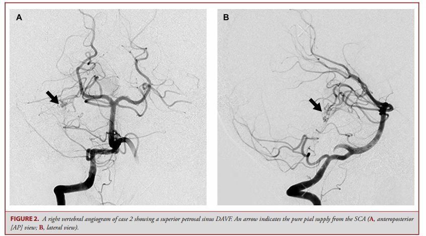 软膜动脉参与供血的颅内硬脑膜动静脉瘘
