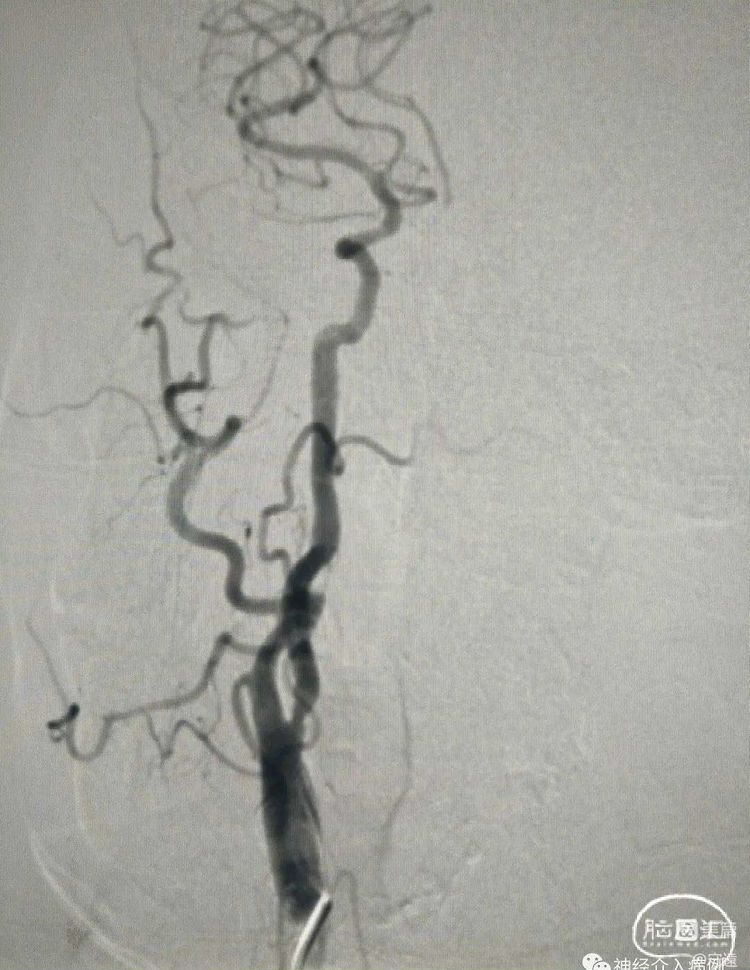 动脉长鞘怎么置入【病例夹】迷走反射的思考一一颈动脉支架置入术后和拔除动脉鞘后迷走反射中西医结合应对策略_https://www.jmylbn.com_新闻资讯_第12张