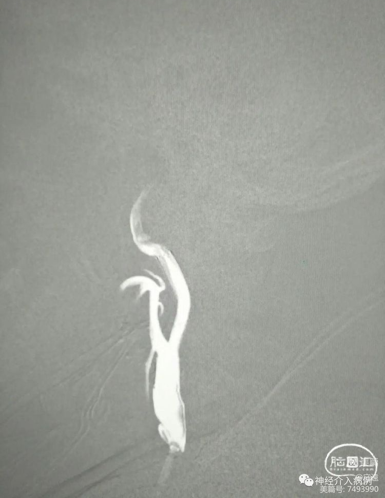 动脉长鞘怎么置入【病例夹】迷走反射的思考一一颈动脉支架置入术后和拔除动脉鞘后迷走反射中西医结合应对策略_https://www.jmylbn.com_新闻资讯_第11张