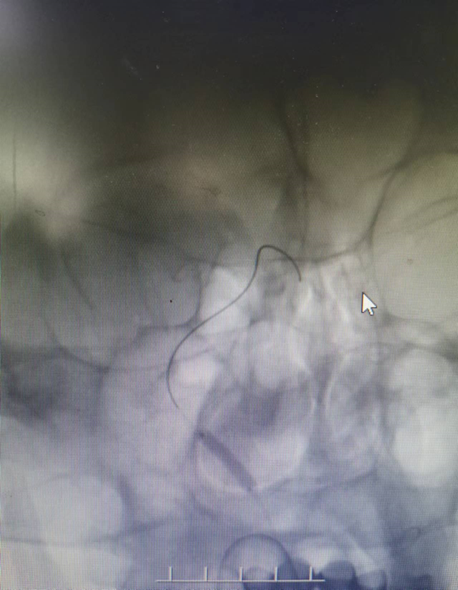 导丝怎么扩【载药时代 球扩天下】NOVA DES®颅内药物洗脱支架在症状性颅内动脉狭窄中的应用—烟台鲁东医院使用体会二例！_https://www.jmylbn.com_新闻资讯_第9张
