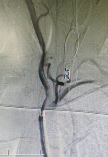 导丝怎么扩【载药时代 球扩天下】NOVA DES®颅内药物洗脱支架在症状性颅内动脉狭窄中的应用—烟台鲁东医院使用体会二例！_https://www.jmylbn.com_新闻资讯_第7张