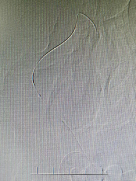 导丝怎么扩【载药时代 球扩天下】NOVA DES®颅内药物洗脱支架在症状性颅内动脉狭窄中的应用—烟台鲁东医院使用体会二例！_https://www.jmylbn.com_新闻资讯_第10张