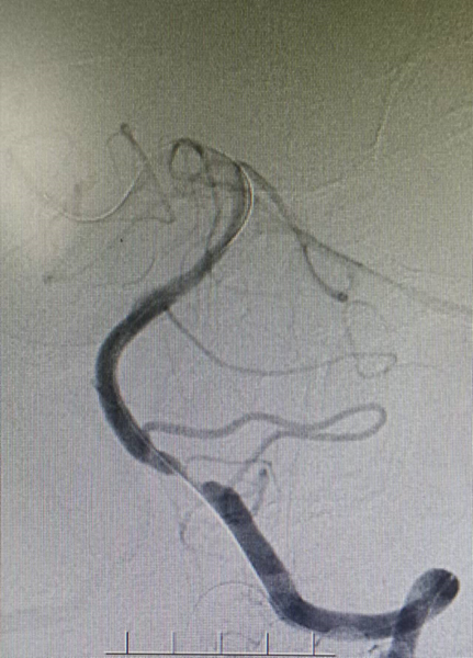导丝怎么扩【载药时代 球扩天下】NOVA DES®颅内药物洗脱支架在症状性颅内动脉狭窄中的应用—烟台鲁东医院使用体会二例！_https://www.jmylbn.com_新闻资讯_第8张