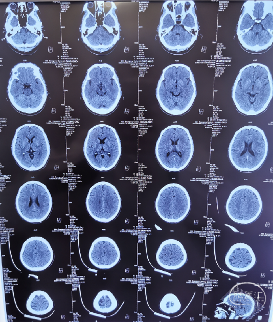 导丝怎么扩【病例夹】​郭宗培副主任团队：左侧大脑中动脉M1闭塞取栓—拉栓？单纯球扩？_https://www.jmylbn.com_新闻资讯_第5张