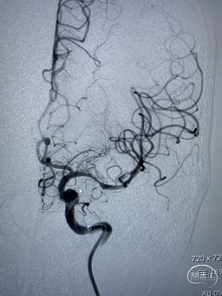 导丝怎么扩【病例夹】​郭宗培副主任团队：左侧大脑中动脉M1闭塞取栓—拉栓？单纯球扩？_https://www.jmylbn.com_新闻资讯_第3张
