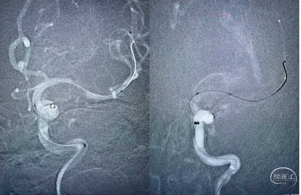 导丝怎么扩【病例夹】​郭宗培副主任团队：左侧大脑中动脉M1闭塞取栓—拉栓？单纯球扩？_https://www.jmylbn.com_新闻资讯_第13张