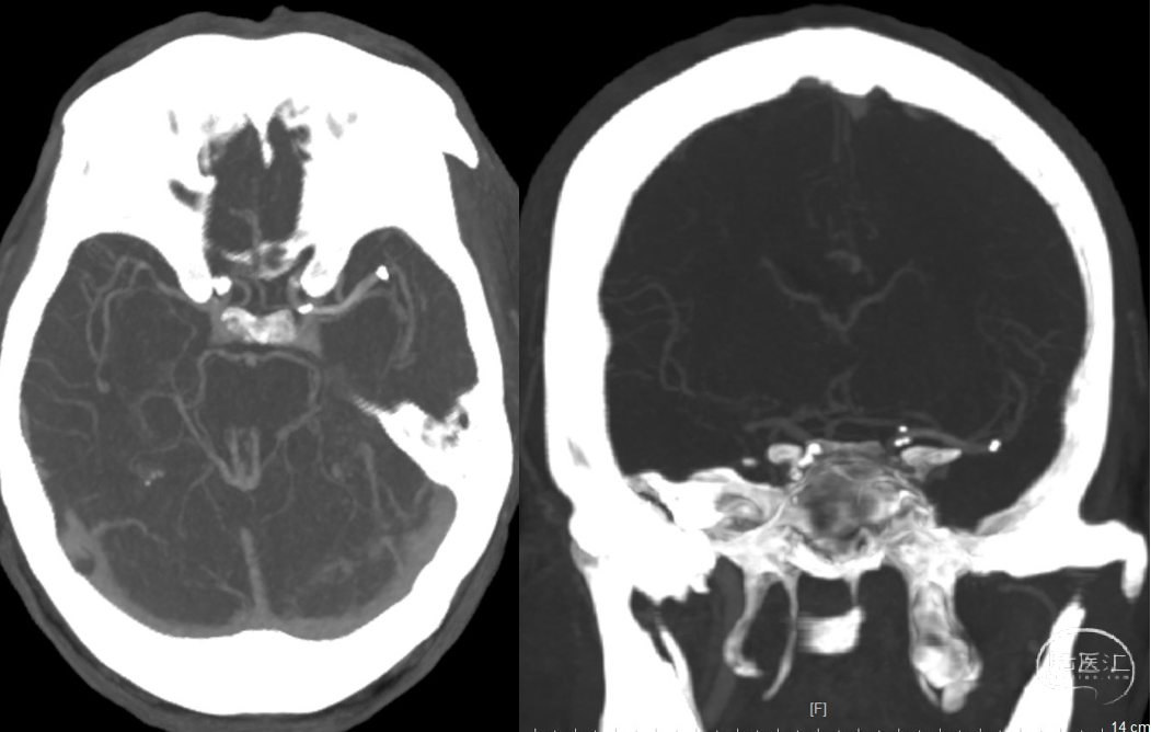 导丝怎么扩【病例夹】​郭宗培副主任团队：左侧大脑中动脉M1闭塞取栓—拉栓？单纯球扩？_https://www.jmylbn.com_新闻资讯_第20张