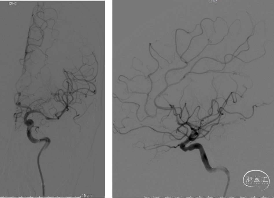 导丝怎么扩【病例夹】​郭宗培副主任团队：左侧大脑中动脉M1闭塞取栓—拉栓？单纯球扩？_https://www.jmylbn.com_新闻资讯_第15张