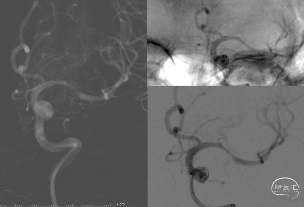 导丝怎么扩【病例夹】​郭宗培副主任团队：左侧大脑中动脉M1闭塞取栓—拉栓？单纯球扩？_https://www.jmylbn.com_新闻资讯_第14张
