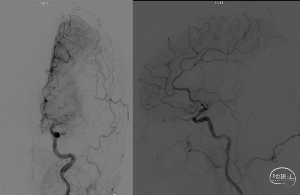 导丝怎么扩【病例夹】​郭宗培副主任团队：左侧大脑中动脉M1闭塞取栓—拉栓？单纯球扩？_https://www.jmylbn.com_新闻资讯_第11张