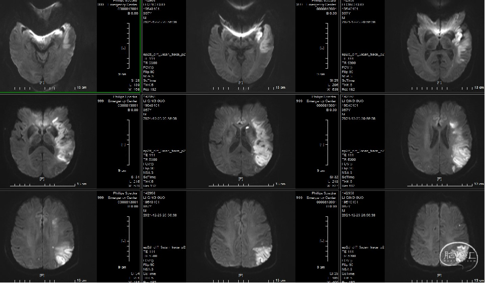导丝怎么扩【病例夹】​郭宗培副主任团队：左侧大脑中动脉M1闭塞取栓—拉栓？单纯球扩？_https://www.jmylbn.com_新闻资讯_第18张