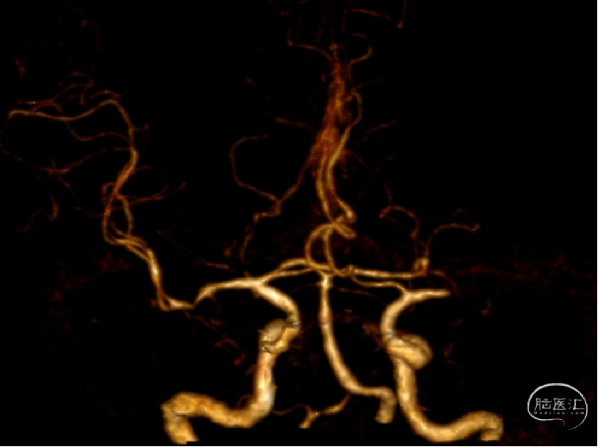 导丝怎么扩【病例夹】​郭宗培副主任团队：左侧大脑中动脉M1闭塞取栓—拉栓？单纯球扩？_https://www.jmylbn.com_新闻资讯_第7张