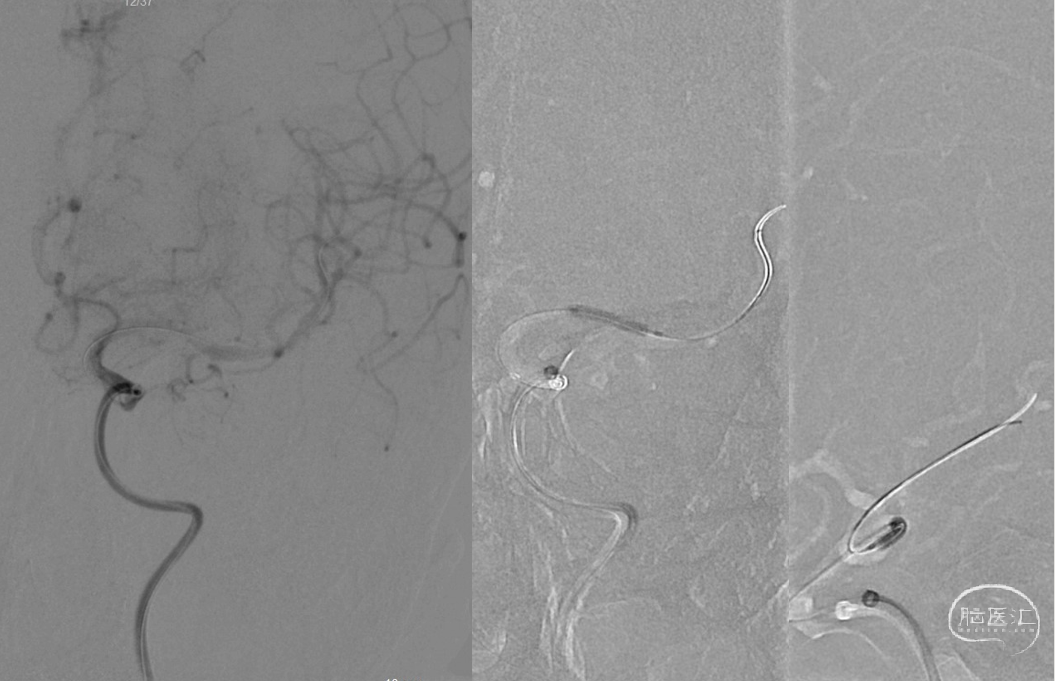 导丝怎么扩【病例夹】​郭宗培副主任团队：左侧大脑中动脉M1闭塞取栓—拉栓？单纯球扩？_https://www.jmylbn.com_新闻资讯_第12张