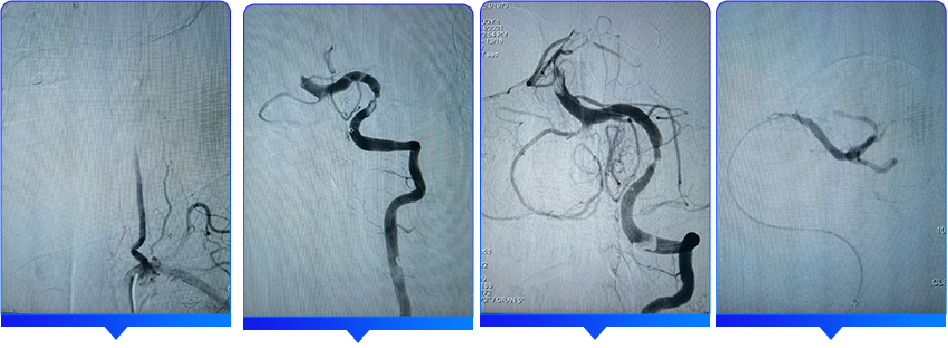血管闭合系统是什么缝闭生辉 ｜ 血管闭合器在颅内动脉取栓术中的应用_https://www.jmylbn.com_新闻资讯_第13张
