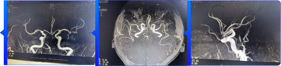 血管闭合系统是什么缝闭生辉 ｜ 血管闭合器在颅内动脉取栓术中的应用_https://www.jmylbn.com_新闻资讯_第7张