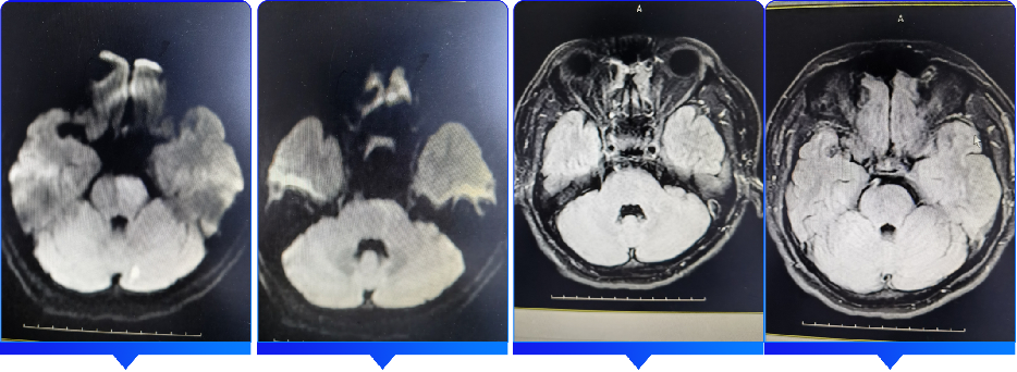 血管闭合系统是什么缝闭生辉 ｜ 血管闭合器在颅内动脉取栓术中的应用_https://www.jmylbn.com_新闻资讯_第8张