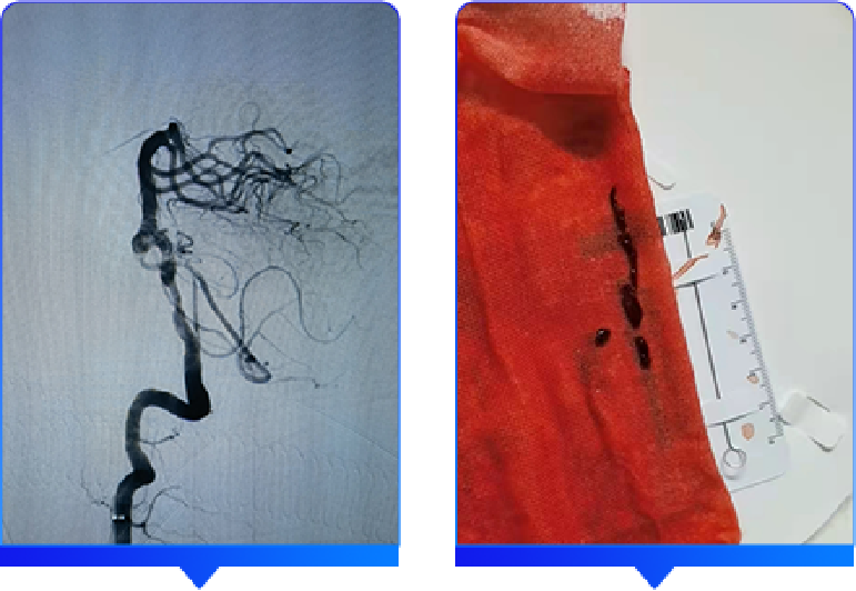 血管闭合系统是什么缝闭生辉 ｜ 血管闭合器在颅内动脉取栓术中的应用_https://www.jmylbn.com_新闻资讯_第15张