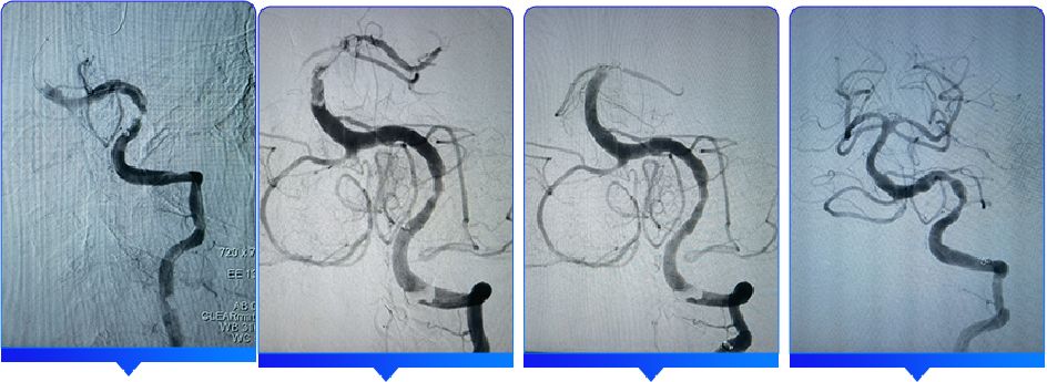 血管闭合系统是什么缝闭生辉 ｜ 血管闭合器在颅内动脉取栓术中的应用_https://www.jmylbn.com_新闻资讯_第14张