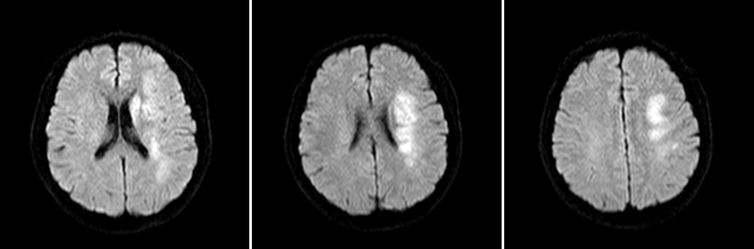 导丝怎么扩【载药时代 球扩天下】NOVA DES®颅内药物球扩支架在大脑中动脉重度狭窄中的应用——济南市第四人民医院使用体会一例！_https://www.jmylbn.com_新闻资讯_第7张