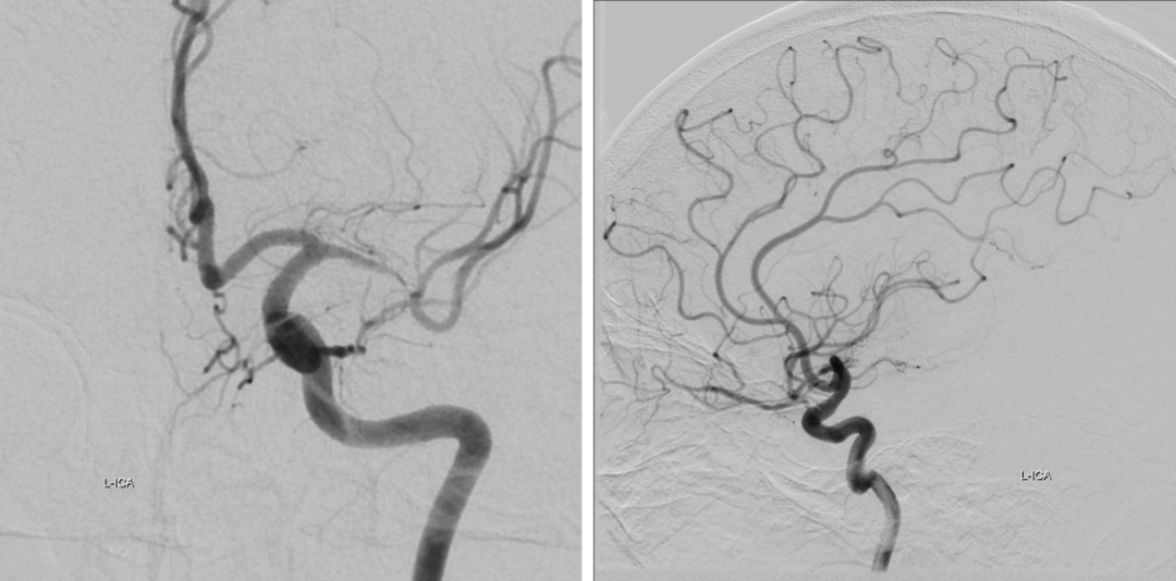 导丝怎么扩【载药时代 球扩天下】NOVA DES®颅内药物球扩支架在大脑中动脉重度狭窄中的应用——济南市第四人民医院使用体会一例！_https://www.jmylbn.com_新闻资讯_第6张
