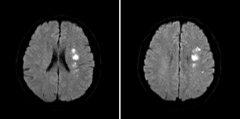 导丝怎么扩【载药时代 球扩天下】NOVA DES®颅内药物球扩支架在大脑中动脉重度狭窄中的应用——济南市第四人民医院使用体会一例！_https://www.jmylbn.com_新闻资讯_第5张