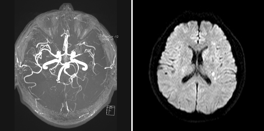 导丝怎么扩【载药时代 球扩天下】NOVA DES®颅内药物球扩支架在大脑中动脉重度狭窄中的应用——济南市第四人民医院使用体会一例！_https://www.jmylbn.com_新闻资讯_第4张