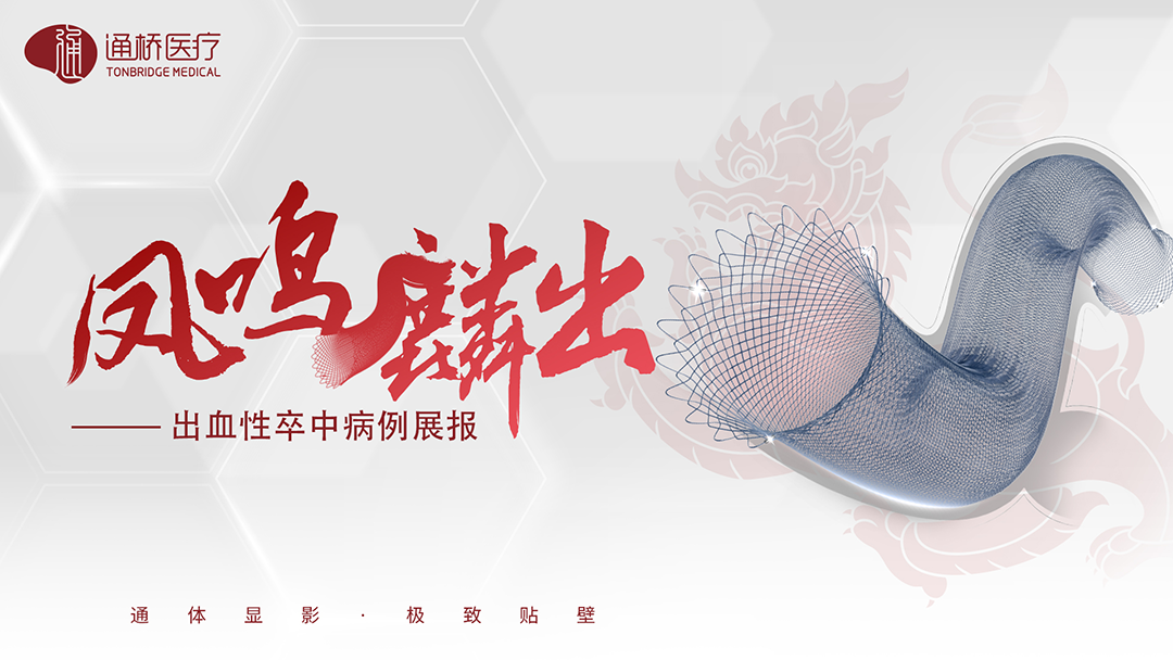什么西蒙导管【通桥•凤鸣麟出】麒麟FD分期治疗双侧未破裂巨大不规则动脉瘤一例-上海聚慕医疗器械有限公司