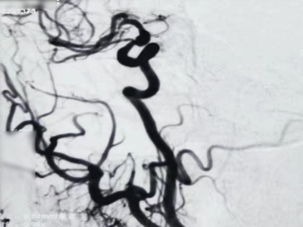 血管鞘组是什么【微妙通远】霍晓川、白晋、邴迎林：谱高PGGuider™导管鞘组联合SmartPioneer™在右侧大脑中动脉重度狭窄中应用一例_https://www.jmylbn.com_新闻资讯_第6张