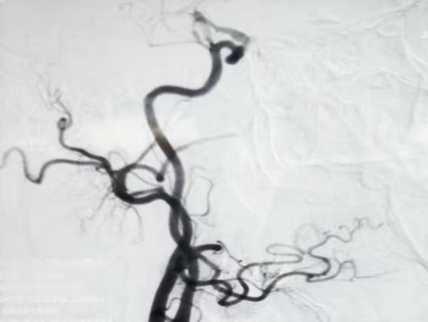 血管鞘组是什么【微妙通远】霍晓川、白晋、邴迎林：谱高PGGuider™导管鞘组联合SmartPioneer™在右侧大脑中动脉重度狭窄中应用一例_https://www.jmylbn.com_新闻资讯_第5张