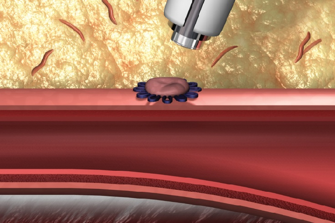 血管闭合系统是什么缝闭生辉 ｜ 血管闭合器在颅内动脉取栓术中的应用_https://www.jmylbn.com_新闻资讯_第18张