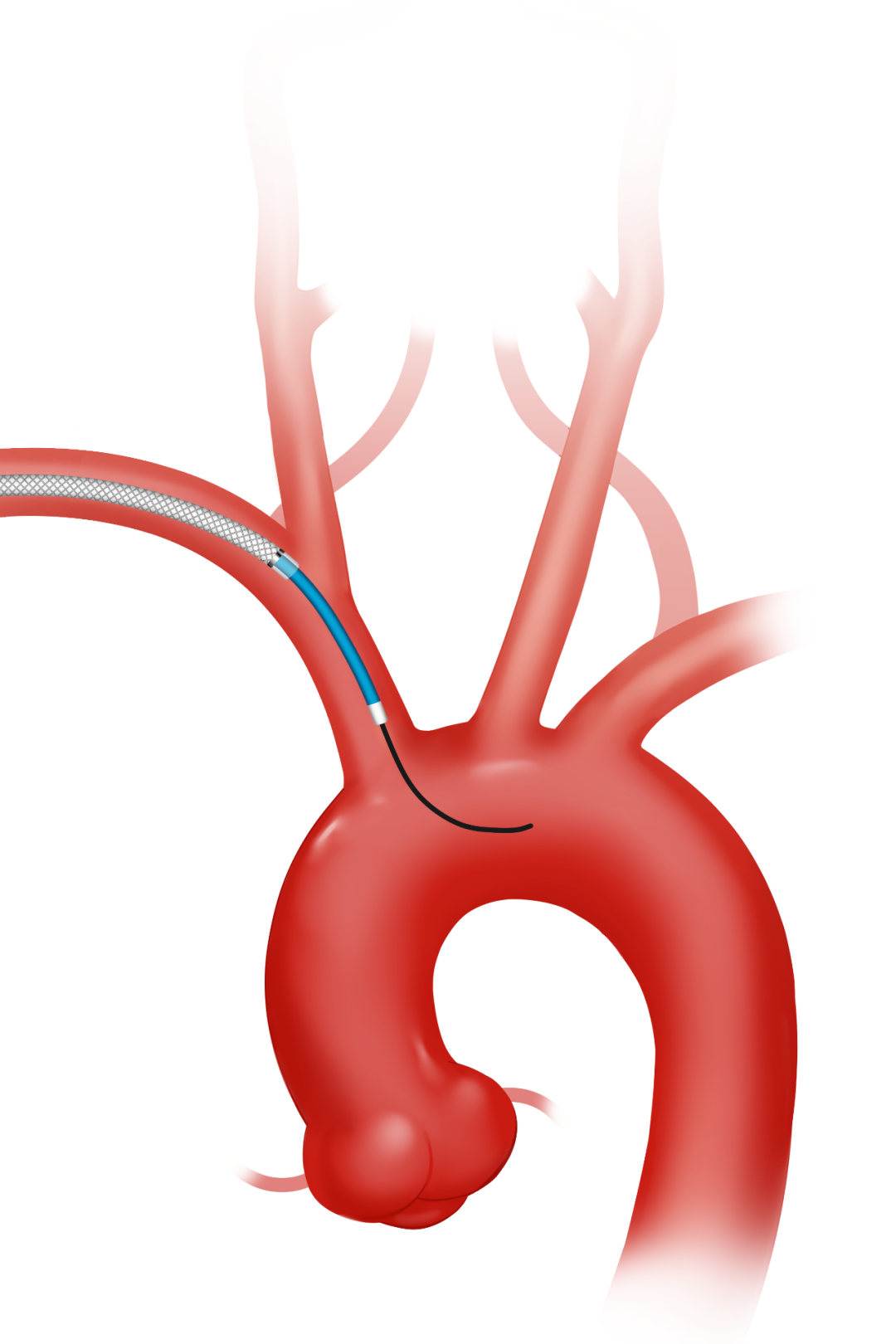 泥鳅导丝怎么用因桡而生 与众不同丨COATS桡动脉专用通路导引系统同轴技术详解_https://www.jmylbn.com_新闻资讯_第9张