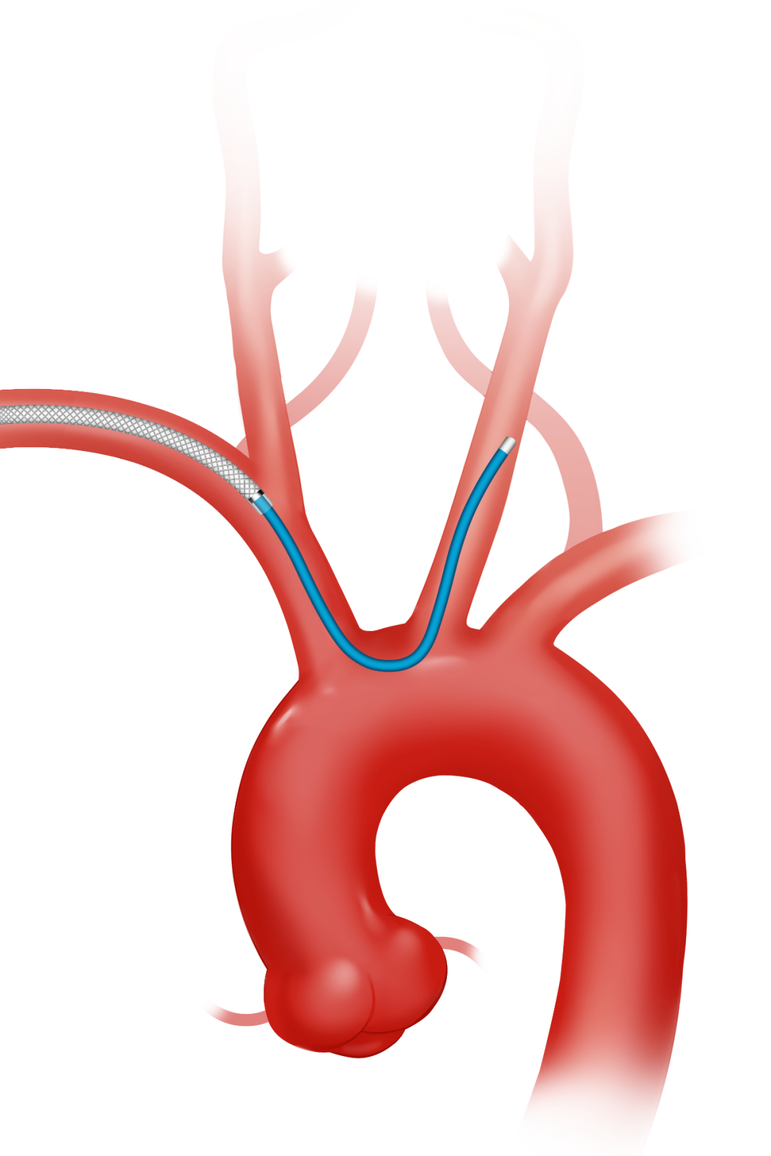 泥鳅导丝怎么用因桡而生 与众不同丨COATS桡动脉专用通路导引系统同轴技术详解_https://www.jmylbn.com_新闻资讯_第13张