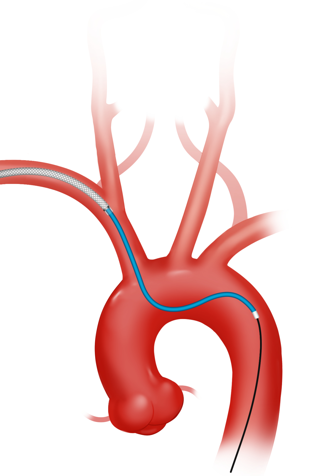 泥鳅导丝怎么用因桡而生 与众不同丨COATS桡动脉专用通路导引系统同轴技术详解_https://www.jmylbn.com_新闻资讯_第10张