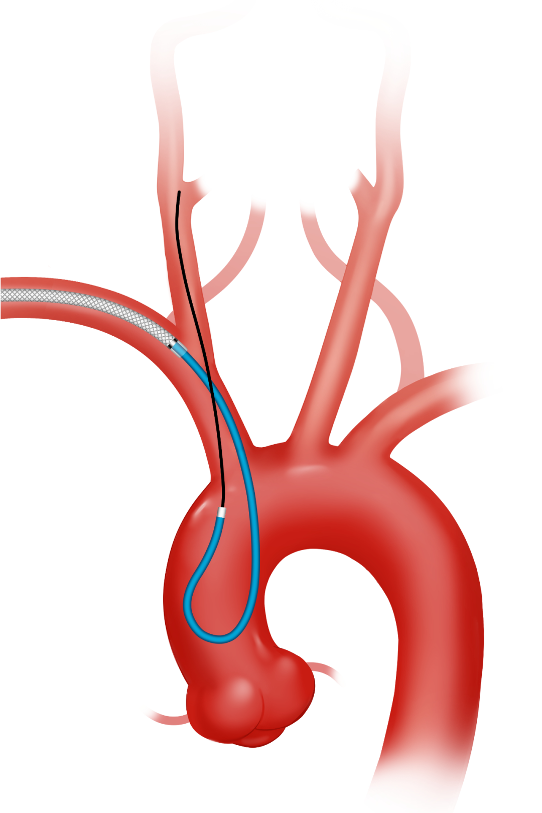 泥鳅导丝怎么用因桡而生 与众不同丨COATS桡动脉专用通路导引系统同轴技术详解_https://www.jmylbn.com_新闻资讯_第11张
