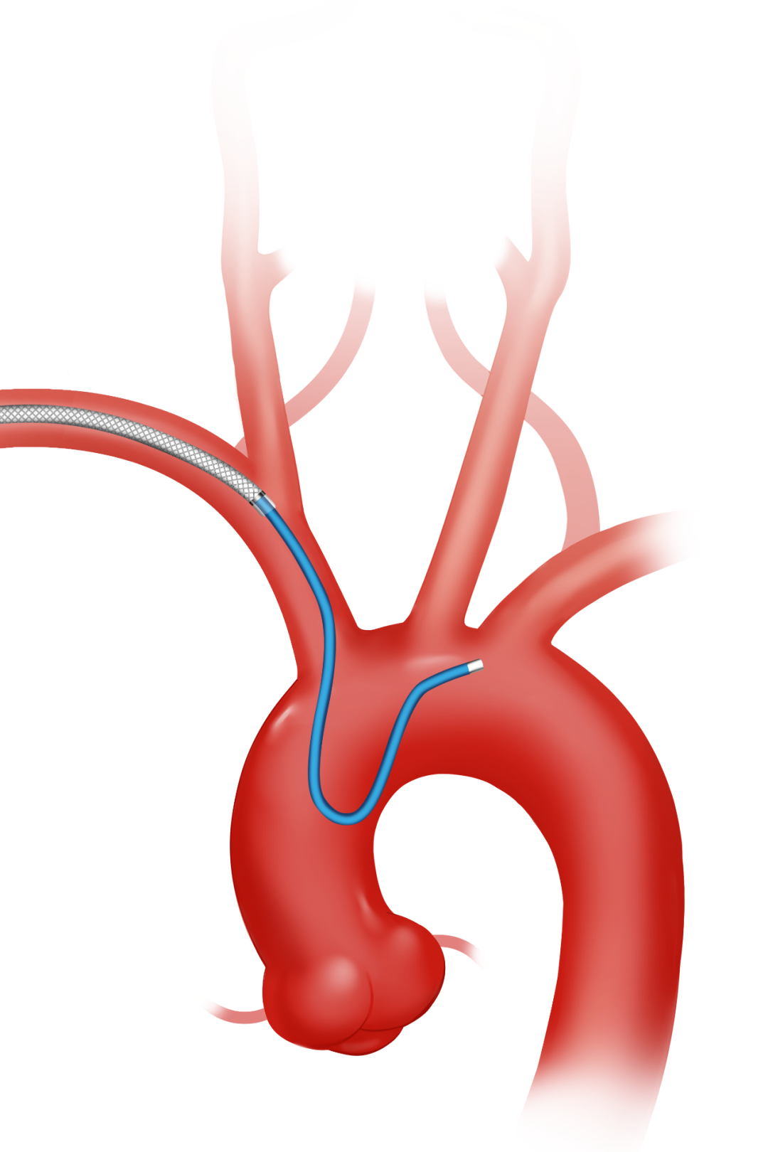 泥鳅导丝怎么用因桡而生 与众不同丨COATS桡动脉专用通路导引系统同轴技术详解_https://www.jmylbn.com_新闻资讯_第12张