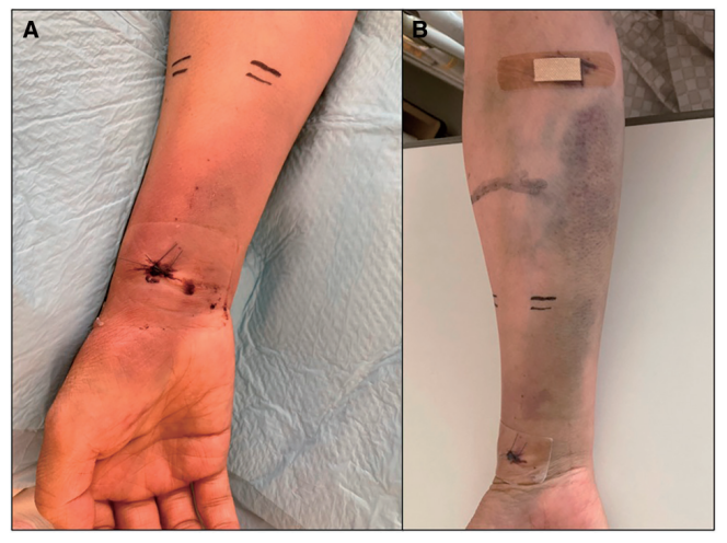 动脉长鞘怎么置入【CNIT专栏】经桡动脉入路难以移除的6F导管鞘：病例报告_https://www.jmylbn.com_新闻资讯_第7张