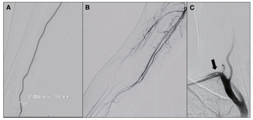 动脉长鞘怎么置入【CNIT专栏】经桡动脉入路难以移除的6F导管鞘：病例报告_https://www.jmylbn.com_新闻资讯_第3张
