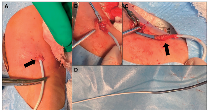 动脉长鞘怎么置入【CNIT专栏】经桡动脉入路难以移除的6F导管鞘：病例报告_https://www.jmylbn.com_新闻资讯_第4张