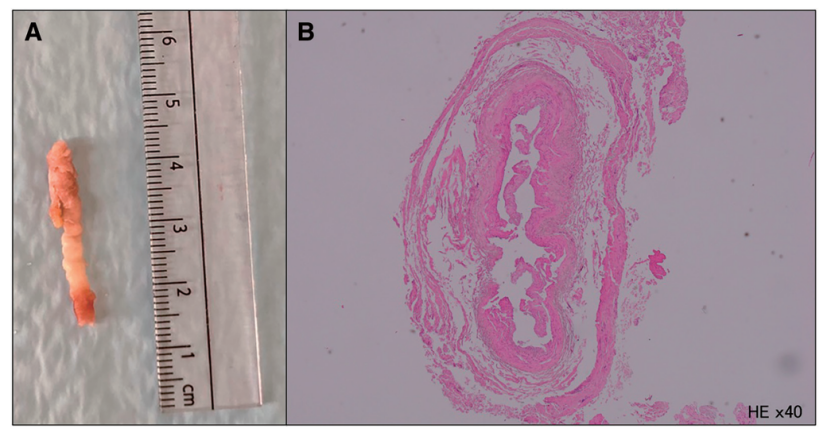 动脉长鞘怎么置入【CNIT专栏】经桡动脉入路难以移除的6F导管鞘：病例报告_https://www.jmylbn.com_新闻资讯_第6张