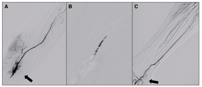 动脉长鞘怎么置入【CNIT专栏】经桡动脉入路难以移除的6F导管鞘：病例报告_https://www.jmylbn.com_新闻资讯_第5张