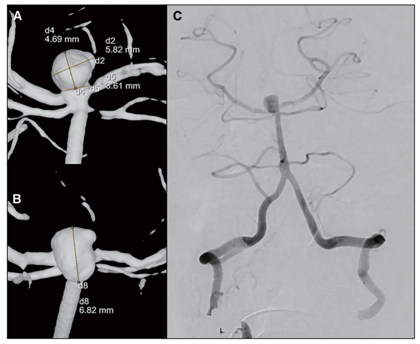 动脉长鞘怎么置入【CNIT专栏】经桡动脉入路难以移除的6F导管鞘：病例报告_https://www.jmylbn.com_新闻资讯_第2张