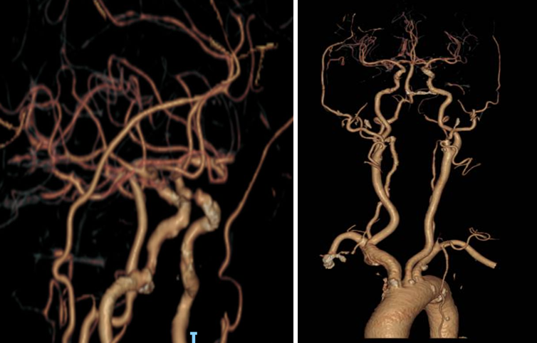 导丝怎么扩【载药时代 球扩天下】NOVA DES®颅内药物洗脱支架在颈内动脉颅内段重度狭窄中的应用体会二例！_https://www.jmylbn.com_新闻资讯_第6张