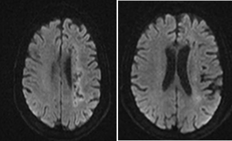 导丝怎么扩【载药时代 球扩天下】NOVA DES®颅内药物洗脱支架在颈内动脉颅内段重度狭窄中的应用体会二例！_https://www.jmylbn.com_新闻资讯_第5张