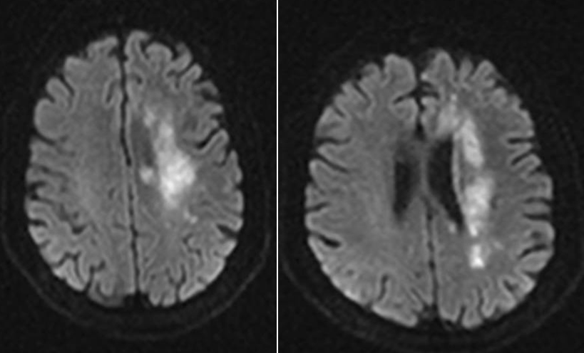 导丝怎么扩【载药时代 球扩天下】NOVA DES®颅内药物洗脱支架在颈内动脉颅内段重度狭窄中的应用体会二例！_https://www.jmylbn.com_新闻资讯_第3张