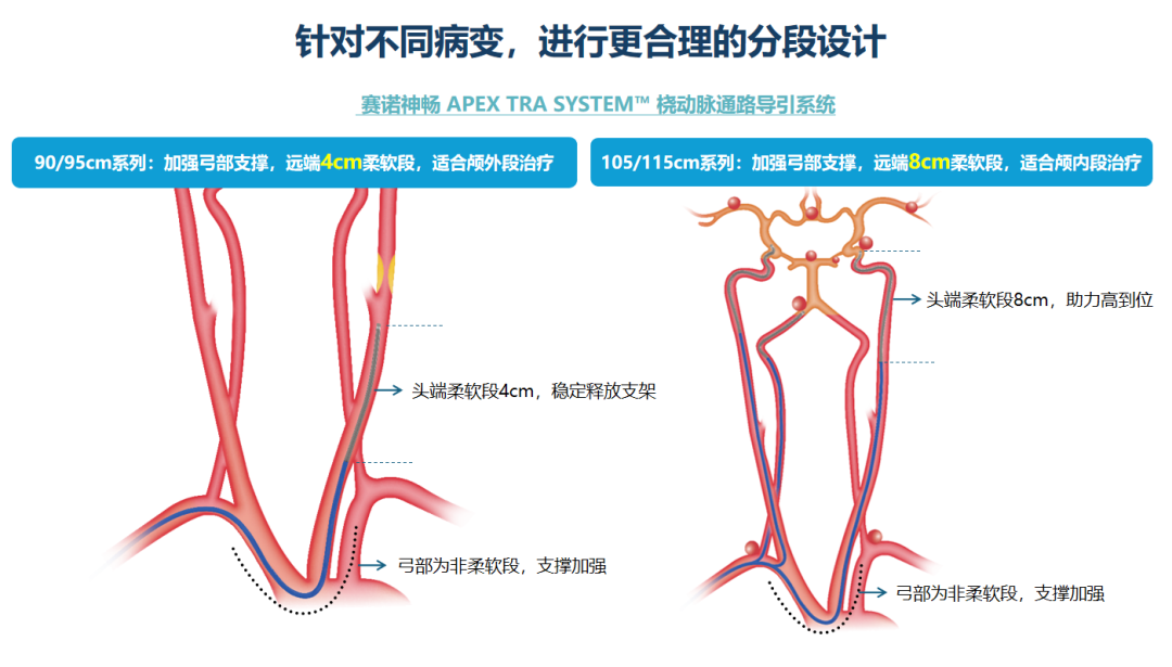泥鳅导丝怎么用因桡而生 与众不同丨COATS桡动脉专用通路导引系统同轴技术详解_https://www.jmylbn.com_新闻资讯_第25张