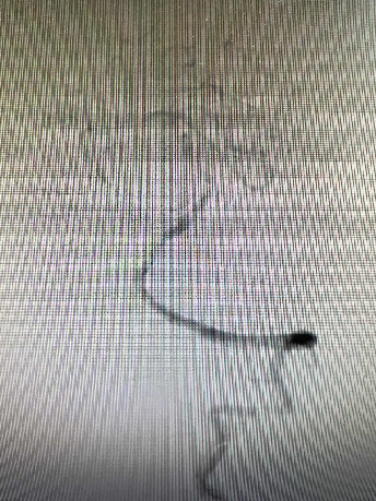 导丝怎么扩【载药时代 球扩天下】NOVA DES®颅内药物洗脱支架在颅内富穿支区域使用体会二例！_https://www.jmylbn.com_新闻资讯_第27张