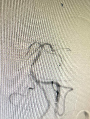 导丝怎么扩【载药时代 球扩天下】NOVA DES®颅内药物洗脱支架在颅内富穿支区域使用体会二例！_https://www.jmylbn.com_新闻资讯_第26张