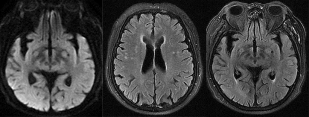 导丝怎么扩【载药时代 球扩天下】NOVA DES®颅内药物洗脱支架在颈内动脉颅内段重度狭窄中的应用体会二例！_https://www.jmylbn.com_新闻资讯_第18张