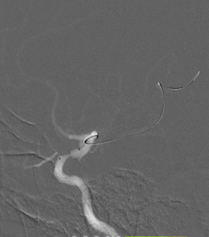 导丝怎么扩【载药时代 球扩天下】NOVA DES®颅内药物洗脱支架在颈内动脉颅内段重度狭窄中的应用体会二例！_https://www.jmylbn.com_新闻资讯_第8张