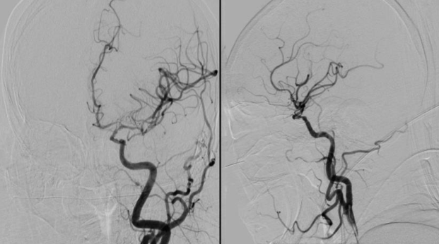 导丝怎么扩【载药时代 球扩天下】NOVA DES®颅内药物洗脱支架在颈内动脉颅内段重度狭窄中的应用体会二例！_https://www.jmylbn.com_新闻资讯_第21张